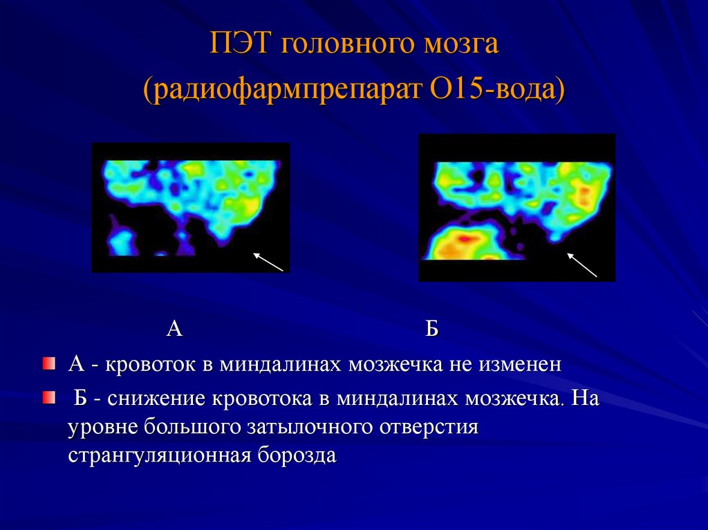 Эмиссионная томография. Позитронно-эмиссионная томография мозга. ПЭТ головного мозга. ПЭТ неврология. Позитронно эмиссионная томография в неврологии.