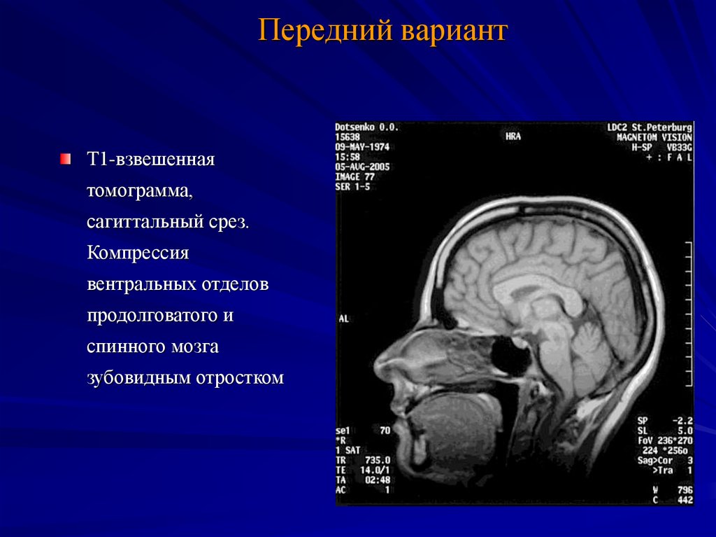 Вентральная дислокация