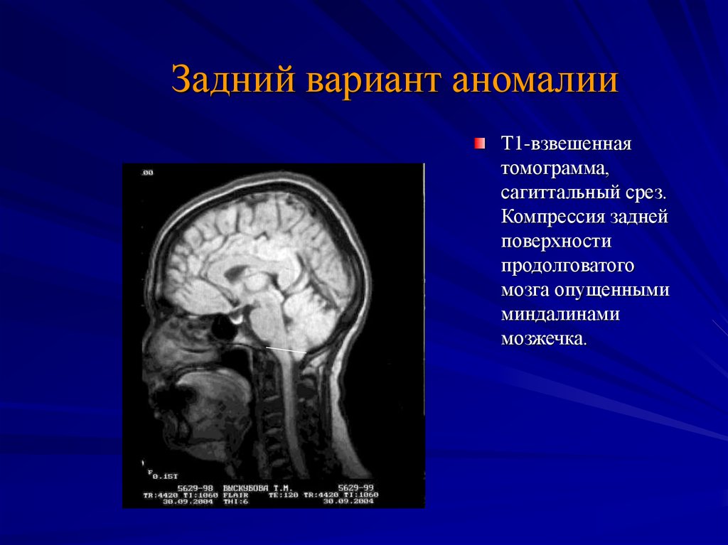 Миндалины мозжечка. Сирингомиелия аномалия Киари. Аномалия мозжечка головного мозга. Мальформация мозжечка.