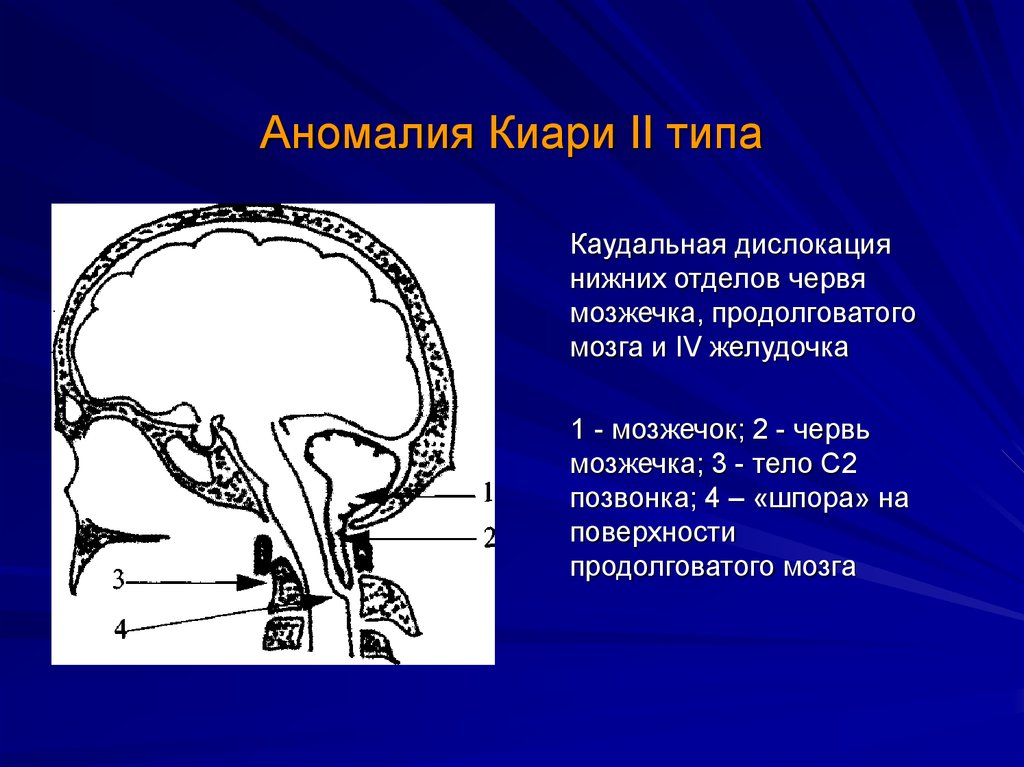 Мозжечок на уровне миндалин. Аномалия Арнольда Киари мозжечок. Эктопия миндалин мозжечка на кт. Каудальное смещение миндалин мозжечка.