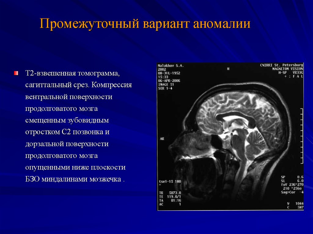 Миндалины мозжечка. Аномалии развития головного мозга. Миндалины мозжечка ниже уровня большого затылочного отверстия. Промежуточный вариант.