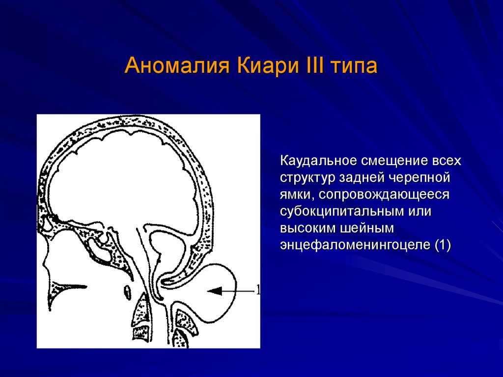 Мр картина аномалии арнольда киари