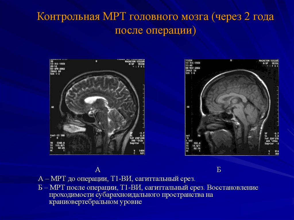 После мрт. Мрт Сагиттальный срез. Мрт головного мозга срезы. Мрт головы Сагиттальный срез. Головной мозг мрт сагитал.