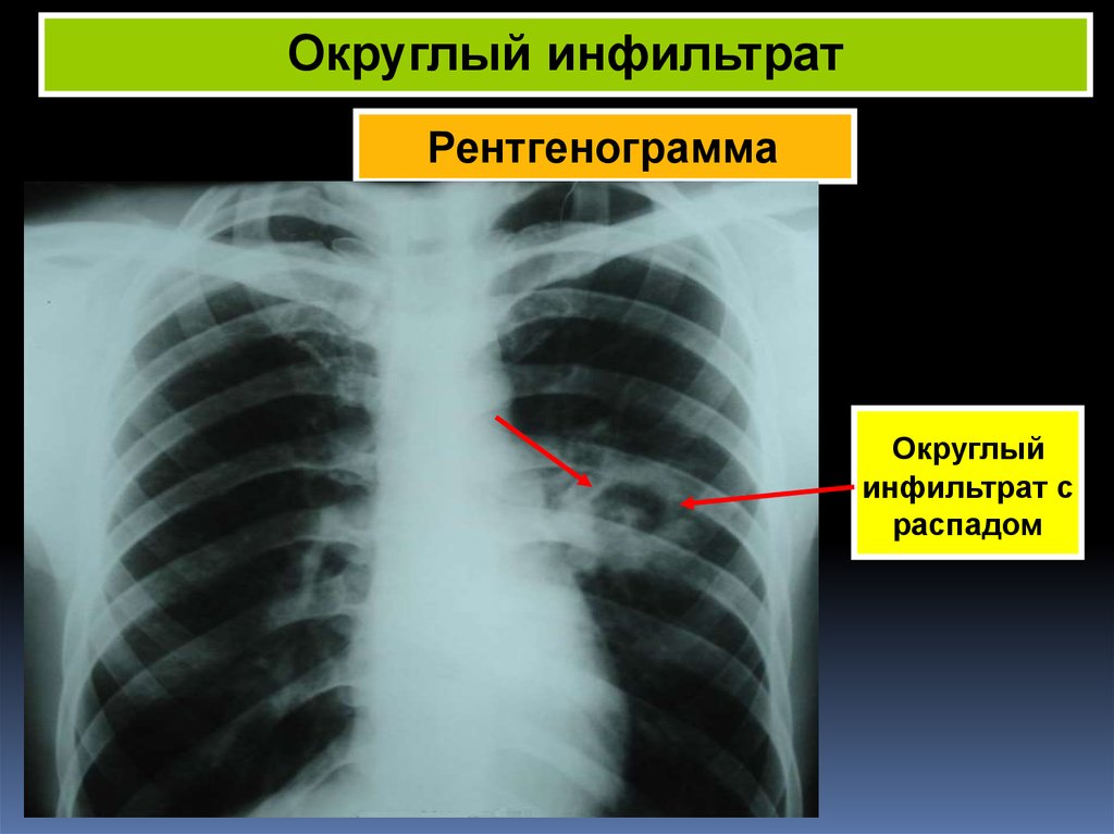 Очаговый туберкулез легких клиническая картина
