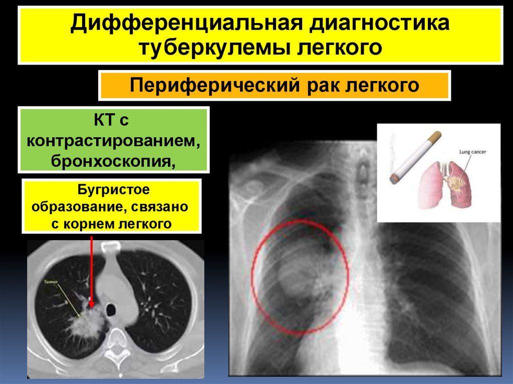 Презентация очаговый туберкулез легких