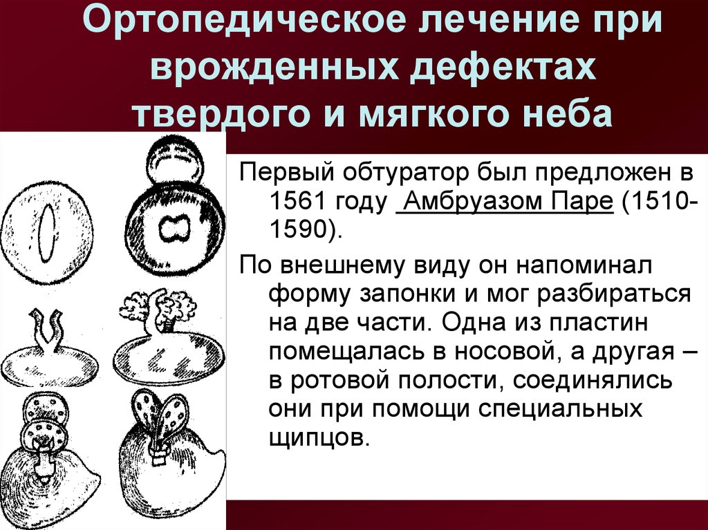 Дефекты лечения. Обтураторы при дефектах твердого неба. Протезирование при дефектах твердого и мягкого неба. Дефекты твердого и мягкого неба по Курляндскому. Классификация врожденных дефектов твердого.