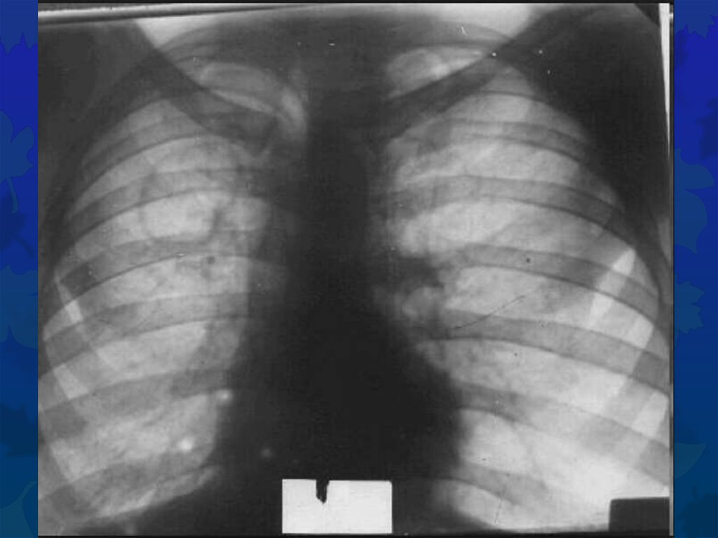 Туберкулез легкого рентгенограмма. Кавернозный туберкулёз ренген. Кавернозный туберкулез рентген. Каверна туберкулез рентген. Фиброзно-кавернозный туберкулез рентген.