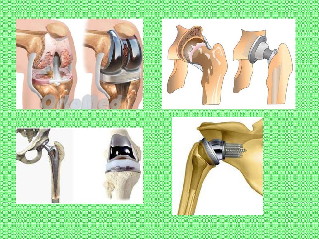 Коленно бедренный сустав. Артропластика коленного сустава. Реверсивное эндопротезирование плечевого сустава. Эндопротезирование: коленный, тазобедренный сустав.