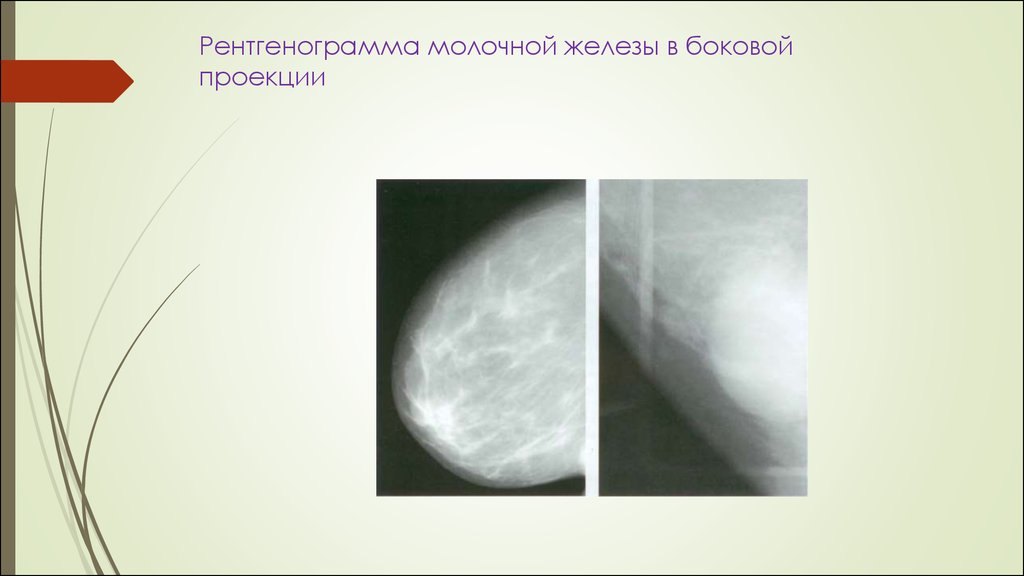 Рак молочной железы метастазы в легких