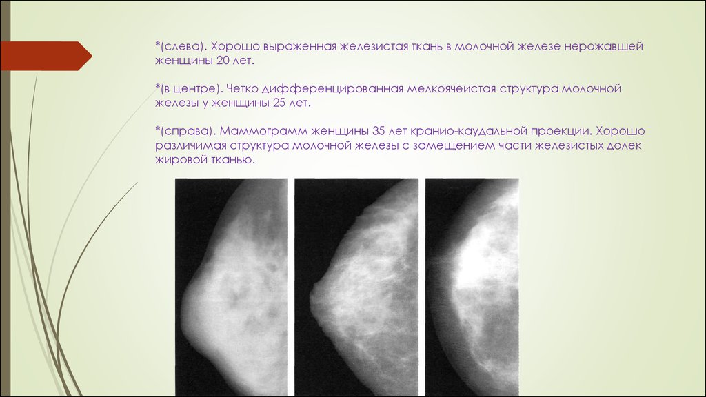 Выделения из сосков при нажатии. Мастопатия молочной железы маммограмма. Кистозно фиброзная мастопатия на маммографии. Структура молочных желез фиброзно-железистая ткань. Фиброзная мастопатия молочной железы на УЗИ.