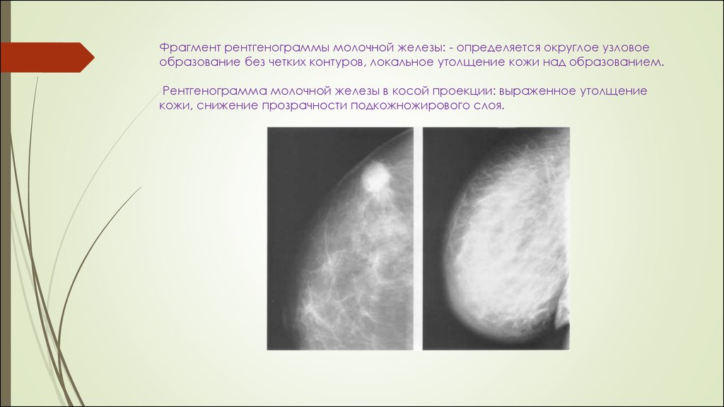 Округлые образования в молочной железе. Узловая мастопатия на маммографии. ФКМ молочной железы рентгенограмма. Узелковая мастопатия молочной железы. Узловая мастопатия молочной железы рентген.