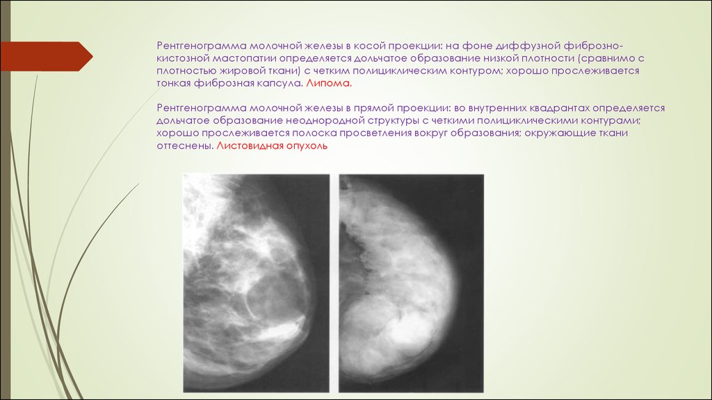 Что означает фиброзное изменение. Фиброзная мастопатия маммограмма. Кистозная мастопатия маммография. Фиброзная мастопатия молочных желез рентген. Фиброзная мастопатия молочной железы маммография.