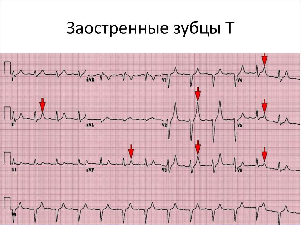 Высокий т на экг причины. ЭКГ высокий зубец т v2-v4. Коронарный зубец т на ЭКГ В грудных отведениях. Остроконечный зубец т на ЭКГ. Высокий заостренный зубец т на ЭКГ.