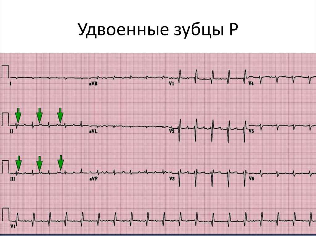 Экг пленка