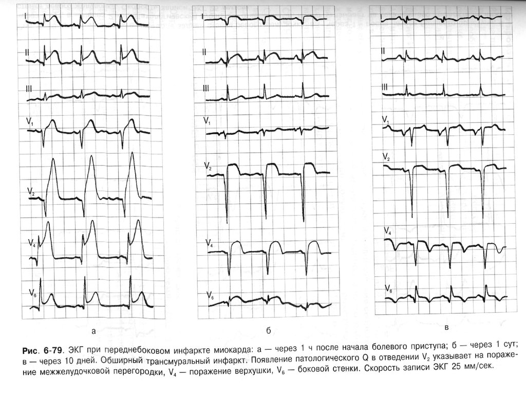 Экг миокард. Инфаркт миокарда на ЭКГ расшифровка. Трансмуральный инфаркт ЭКГ признаки. Острый трансмуральный переднебоковой инфаркт миокарда ЭКГ. ЭКГ при переднебоковом инфаркте миокарда.