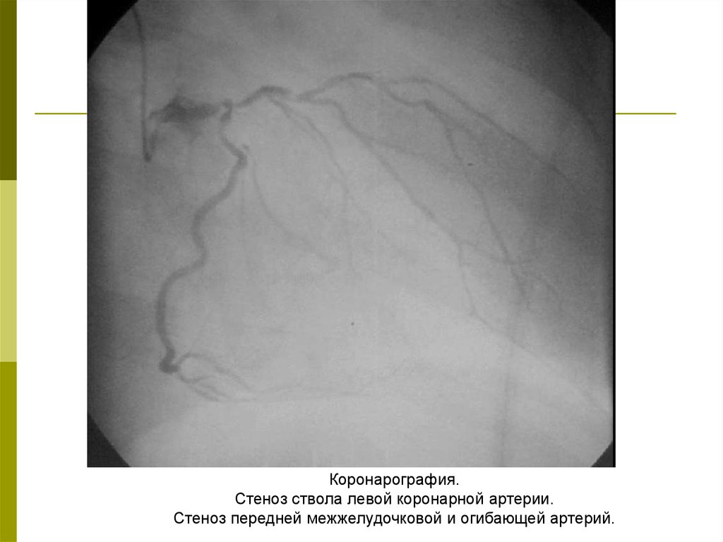 Стеноз артерий сердца. Коронароангиография стеноз. Коронарные артерии стеноз коронарография. Окклюзия левой коронарной артерии коронарография. Стеноз коронарной артерии ангиография.