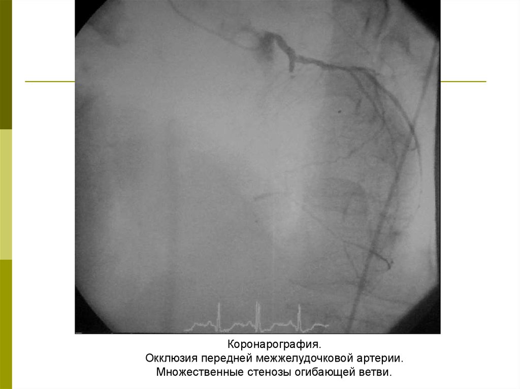 Коронарная окклюзия. Окклюзия коронарной артерии на коронарографии. Коронарография стеноз ПМЖВ. Стеноз огибающей артерии. Окклюзия огибающей артерии.