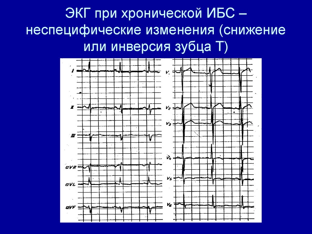 Болезни на экг. Изменения на ЭКГ при ишемической болезни сердца. ЭКГ при хронической ишемической болезни сердца. ЭКГ при ишемической болезни сердца расшифровка. Электрокардиограмма при ишемической болезни сердца.