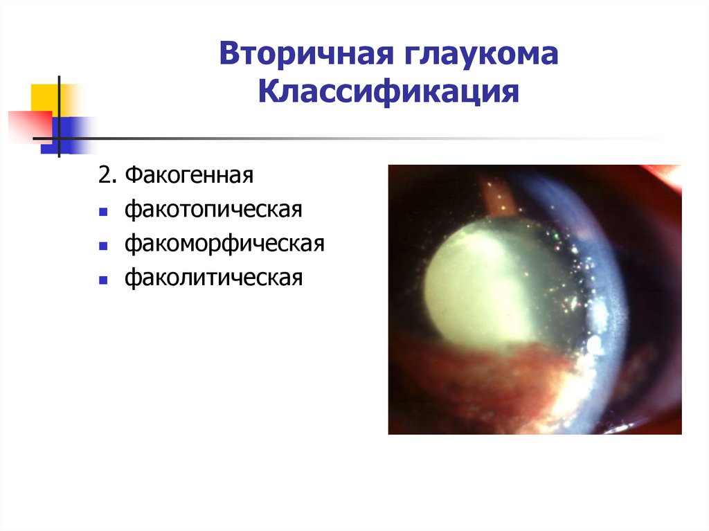Классификация глаукомы. Факолитическая глаукома. Факоморфическая катаракта. Вторичная факогенная глаукома.