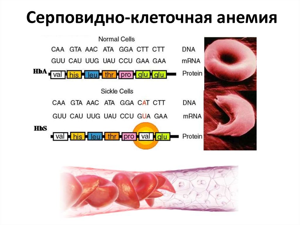 Серповидноклеточная анемия какая