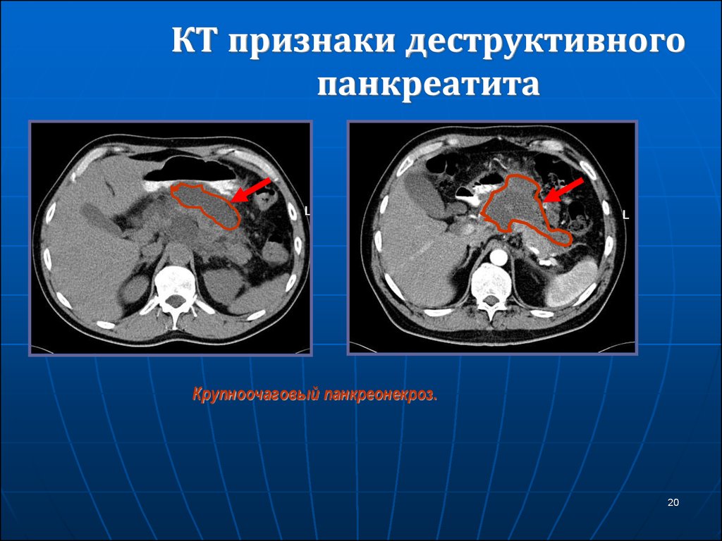 Кт картина панкреатита