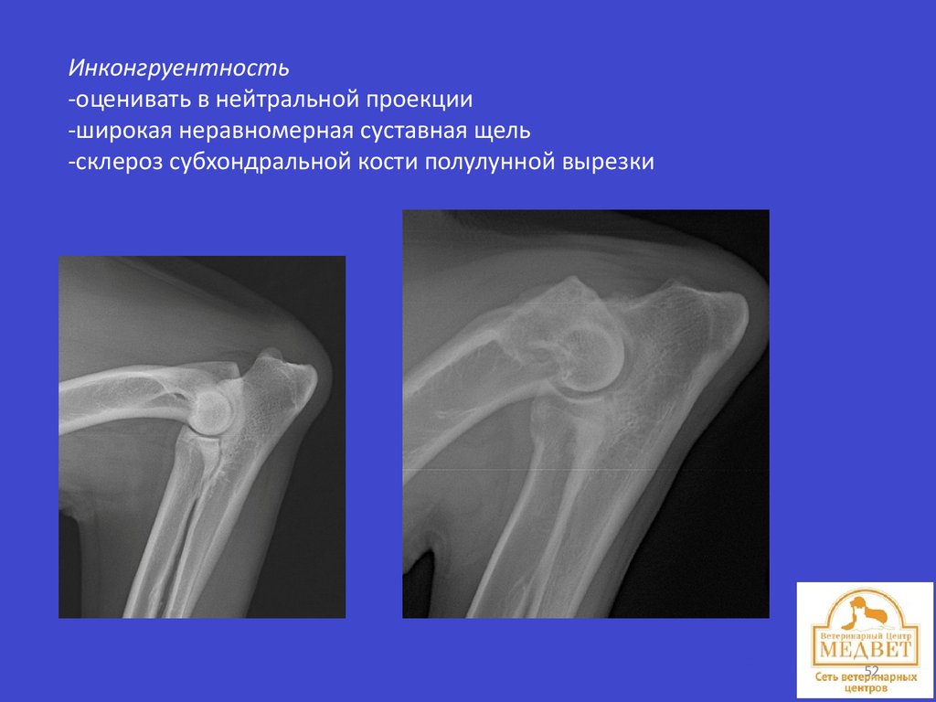 Субхондральный склероз суставных поверхностей коленного сустава. Неравномерная суставная щель. Субхондральный склероз лучевой кости. Полулунная вырезка кости.