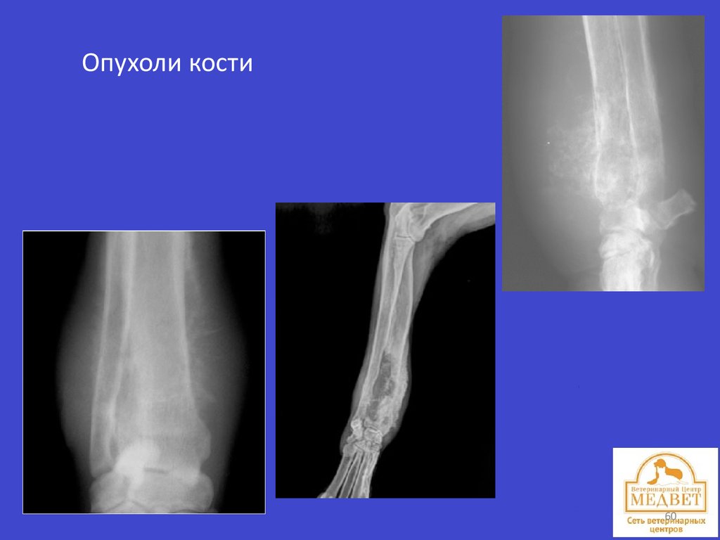 Костный отек. Опухоли костей и суставов.