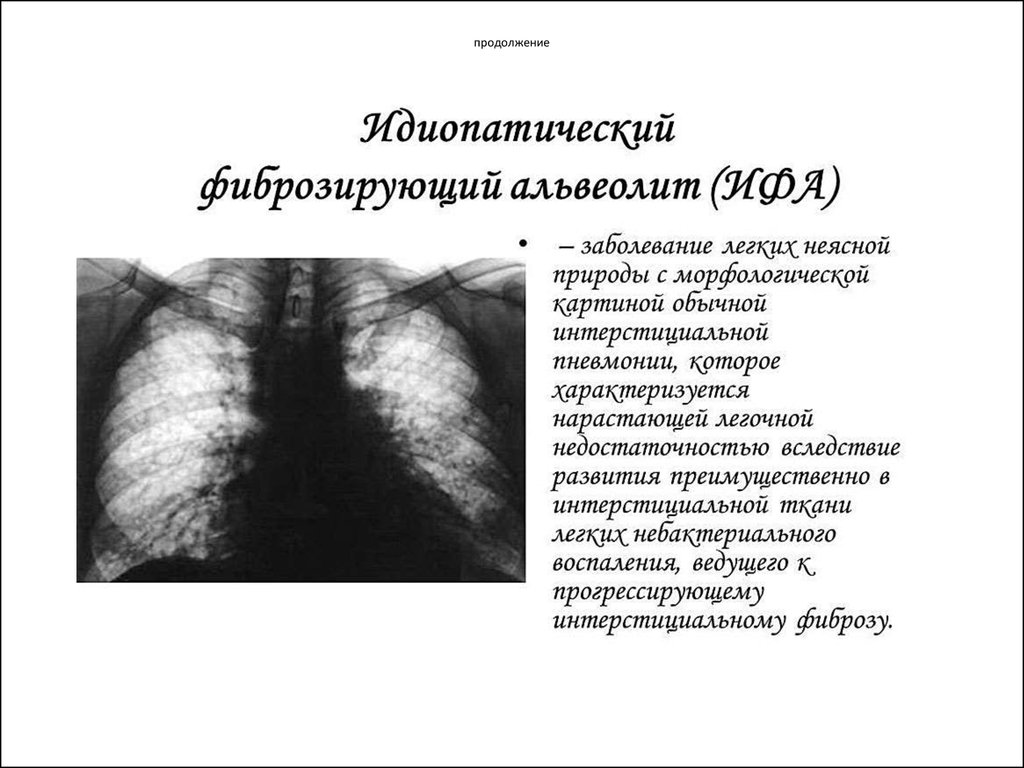 Картина фиброзных изменений. Идиопатический легочный фиброз рентген. Фиброзирующий альвеолит (синдром Хаммена-Рича).. Рентген при фиброзирующем альвеолите. Альвеолит фиброзирующий идиопатический терапия.