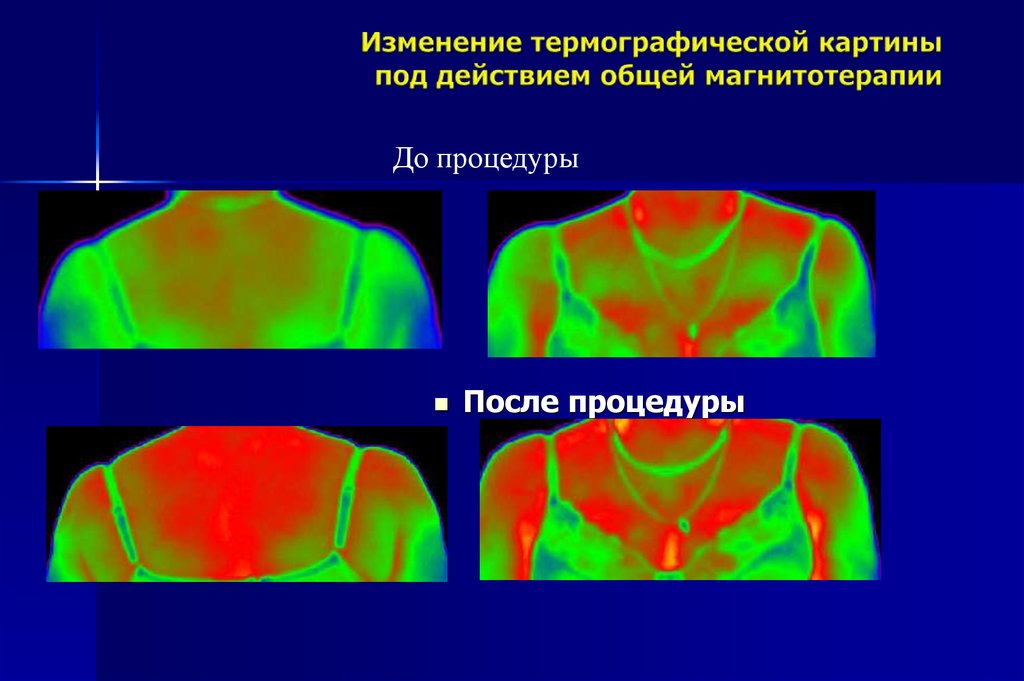 Принципы магнитотерапии. Механизм действия магнитотерапии на организм человека. Низкочастотные магнитные поля медицина. Магнитотерапия механизм действия. Принцип действия магнитотерапии.