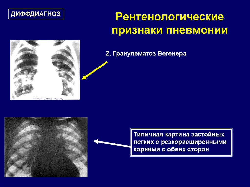 Признаки пневмонии на рентгене