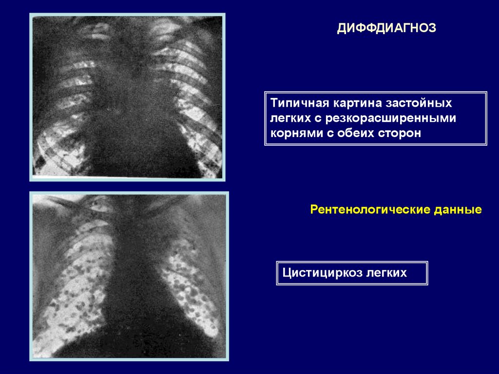 Диета при пневмонии no