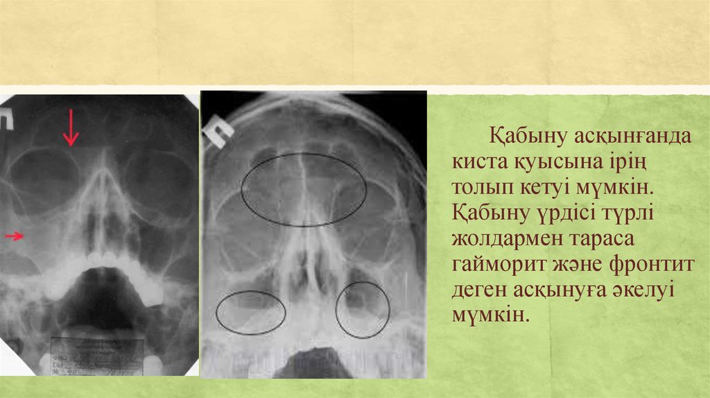 Фронтит от какого слова. Фронтит трепанопункция.