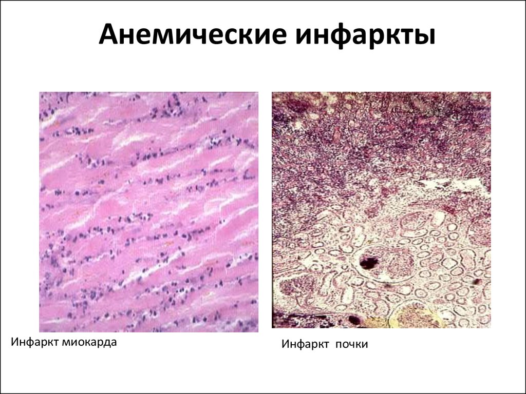 Ишемический инфаркт. Анемический (ишемический) инфаркт почки:. Анемический инфаркт почки микропрепарат. Ишемический инфаркт почки макропрепарат. Анемическлий инфаркт поски микропепарат.