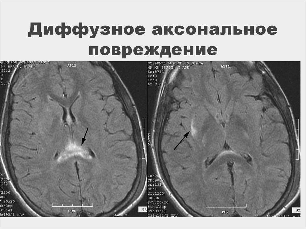 Диффузная травма. Диффузное аксональное поражение головного мозга. Диффузно аксональные повреждения головного мозга кт. Диффузное аксональное повреждение ДАП головного мозга. Диффузное аксональное повреждение головного мозга ЧМТ.