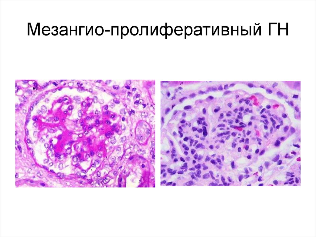 Морфологическая картина гломерулонефрита