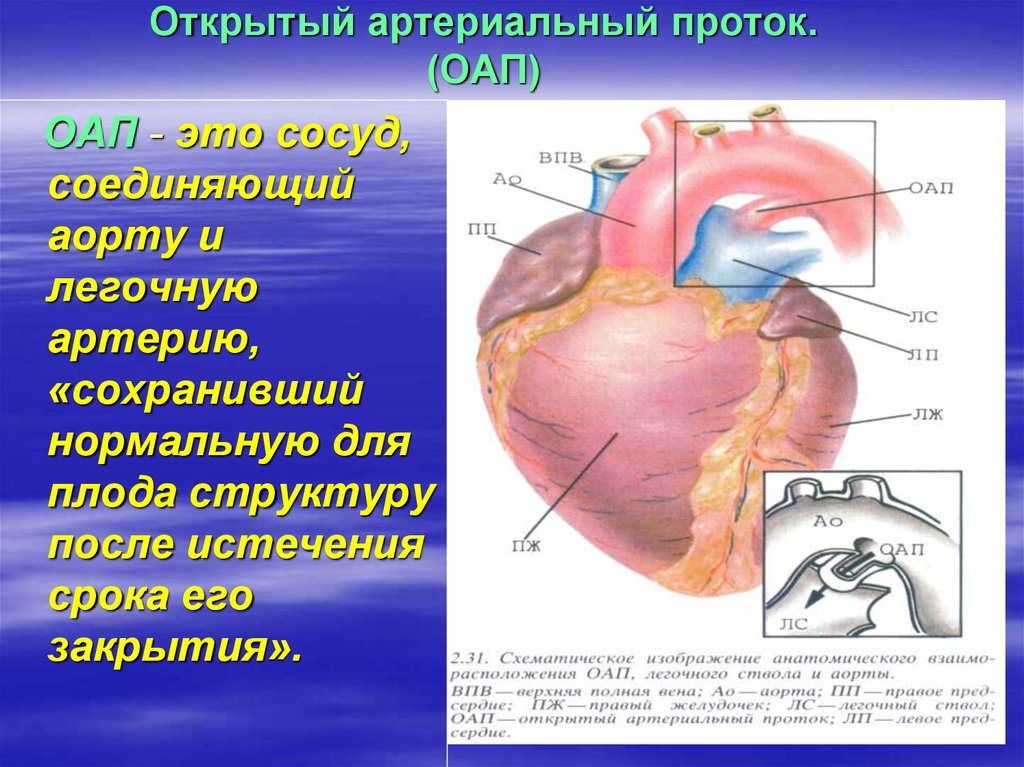 Оап у новорожденных. Открытый артериальный проток порок. ВПС открытый артериальный проток. Открытый артериальный проток (ОАП). Открытый боталлов проток.