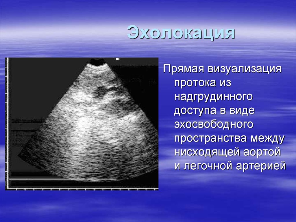 Эхолокация. Эхолокация затруднена о сердце. Визуализация эхолокации. Звуколокация.