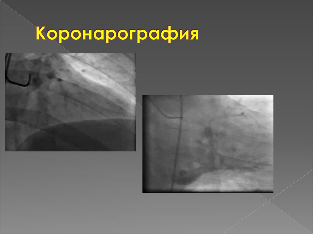 Коронарография сосудов последствия