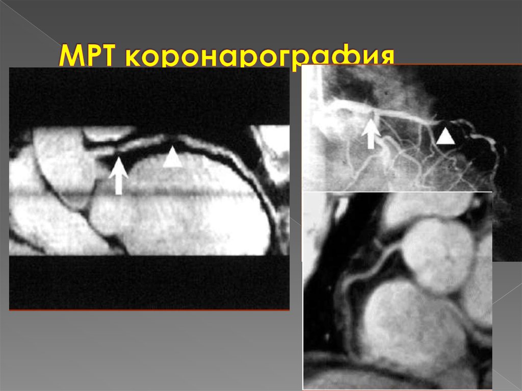 МРТ коронарография