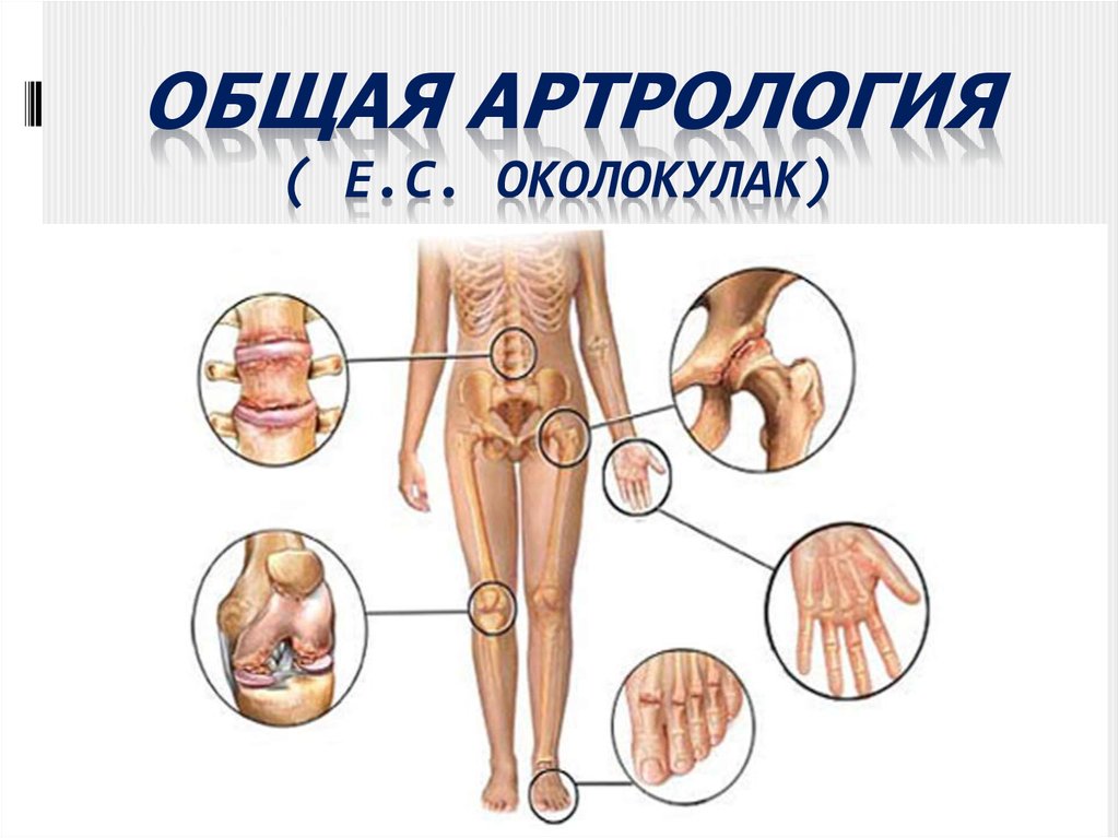 Артрология. Ревматоидный артрит през. Ревматический артрит клиника.