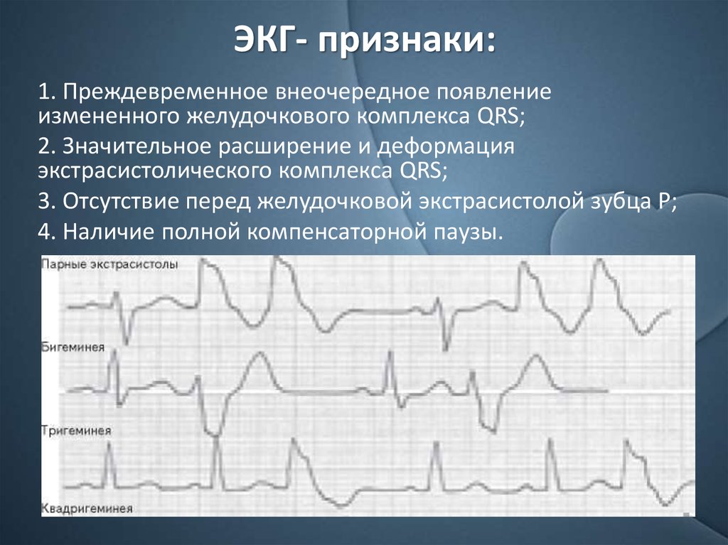 Комплекс экг. Расширение QRS на ЭКГ. Расширение комплекса QRS на ЭКГ. Комплекс QRS на ЭКГ. Отсутствие комплекса QRS на ЭКГ.