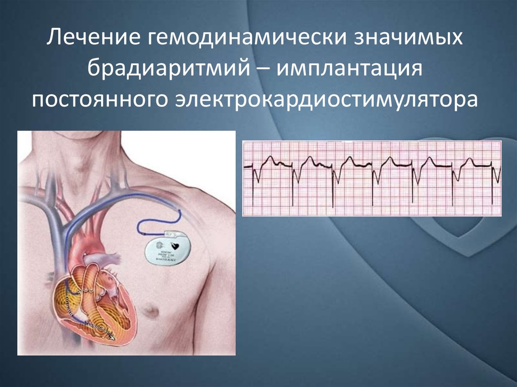 Экг с кардиостимулятором картинки