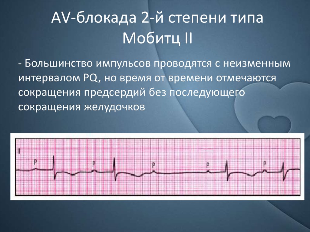 Ав блокада. АВ блокады 2 степени Мобиц 2 на ЭКГ. Атриовентрикулярная блокада Мобитц 1 2. Атриовентрикулярная блокада Мобитц 1 на ЭКГ. АВ блокада 2 степени Мобитц 2 на ЭКГ 2:1.