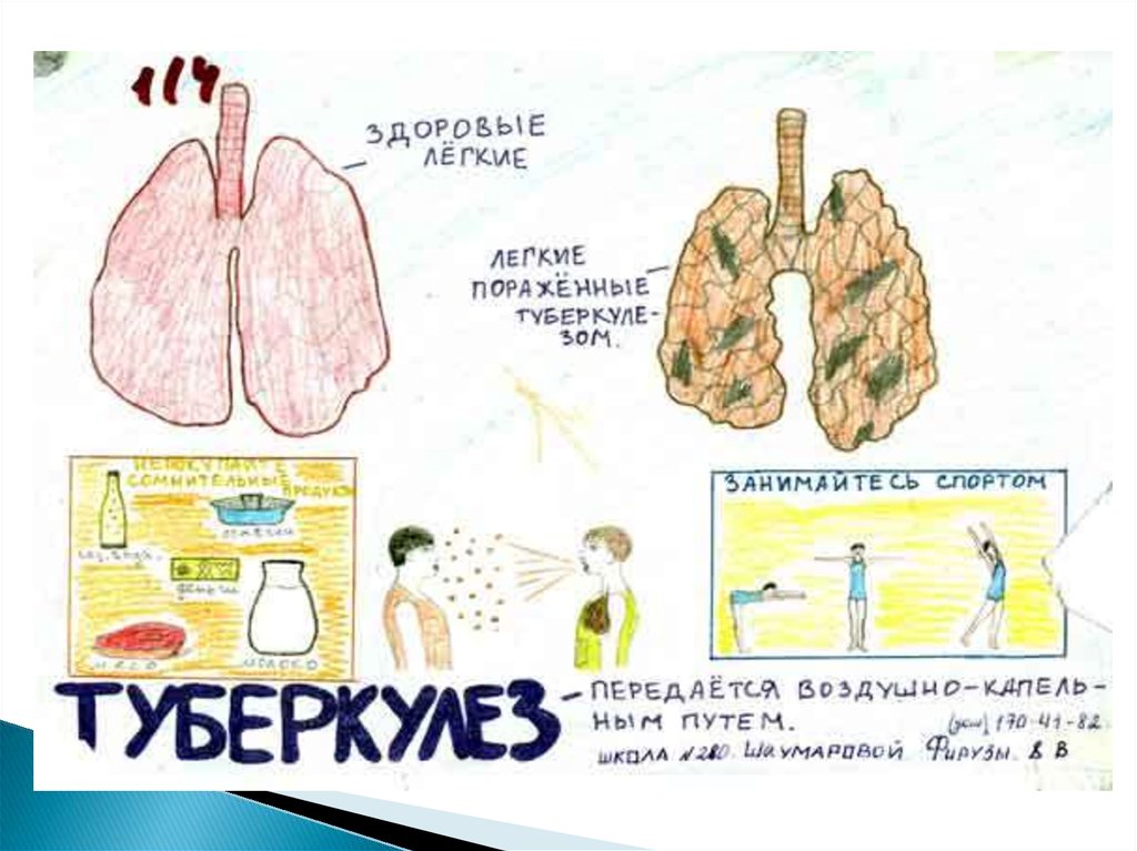 Туберкулез 5 класс. Туберкулез рисунок. Болезни органов дыхания легкие. Рисунок на тему туберкулез легких.