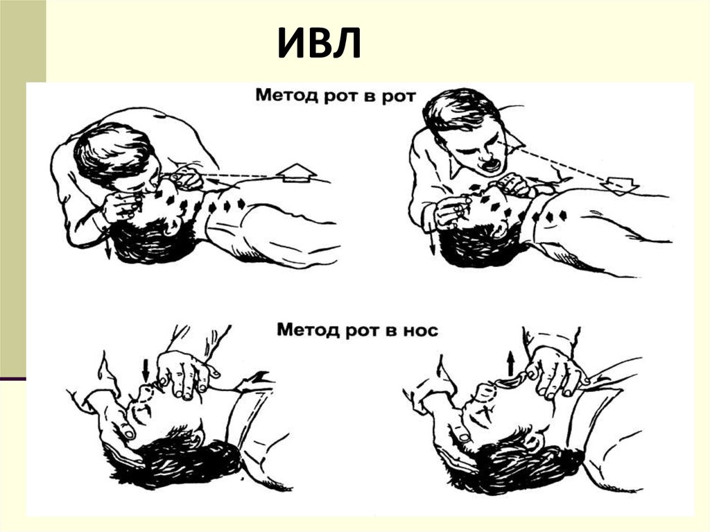 Искусственная вентиляция легких картинки