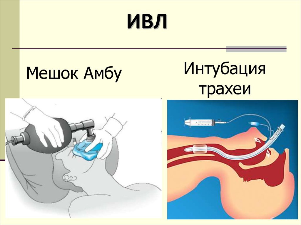 Сердечно легочная недостаточность карта вызова