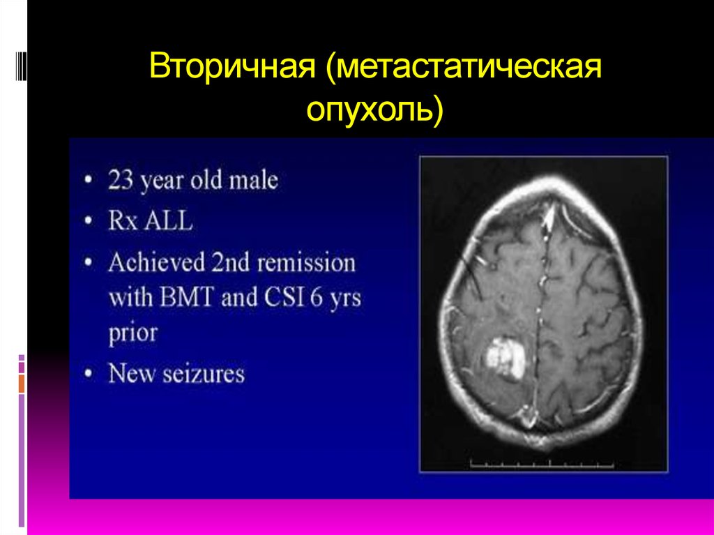 Опухоль головного мозга презентация