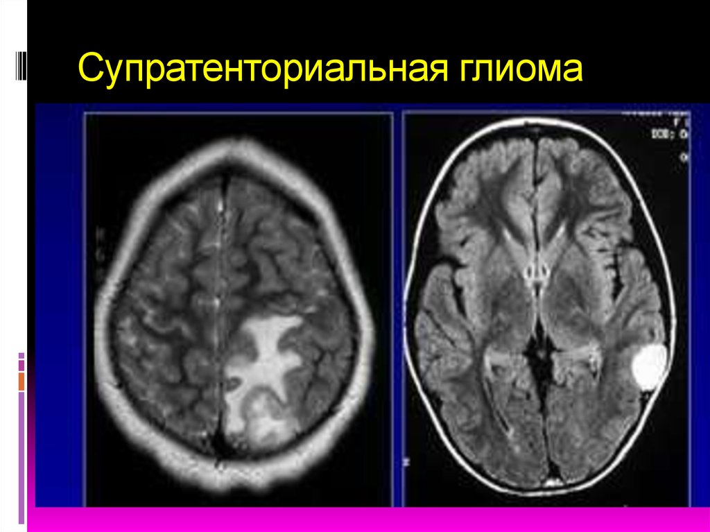 Опухоли головного и спинного мозга презентация