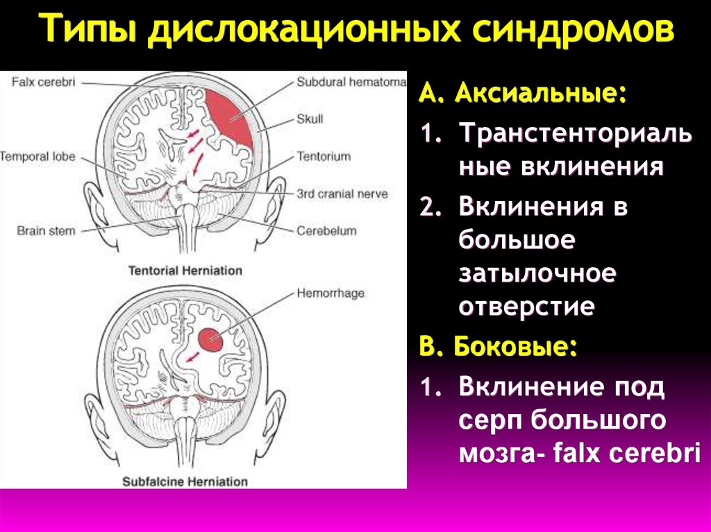 Синдром головного мозга. Вклинение ствола головного мозга в большое затылочное отверстие. Тенториальный дислокационный синдром. Дислокационные синдромы этиология. Дислокационный синдром лобной доли.