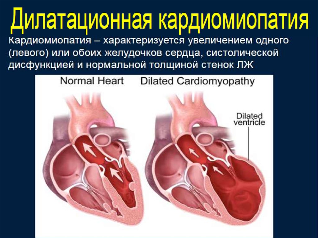 Дилатационная кардиомиопатия презентация